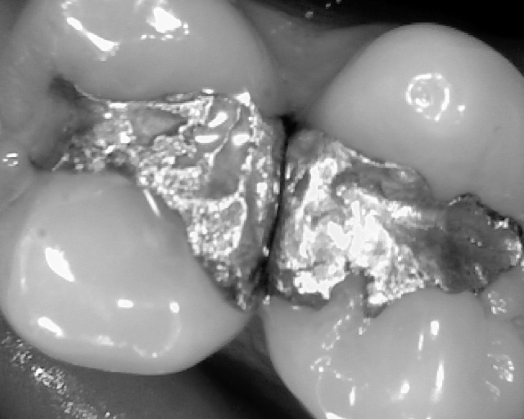 Woman Finds Her Symptoms Of MS Were Actually Caused By Mercury In Dental Fillings