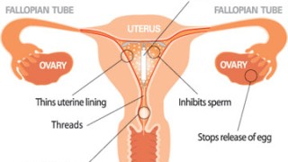 Treating The Mirena Removal Side Effects