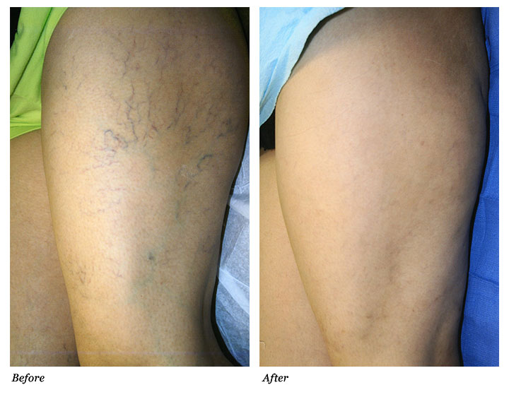Spider Vein Treatment – What Is It All About?