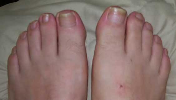 Laser Treatment - Is It Worth Trying In Case Of Toenail Fungus?