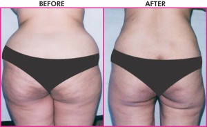 Different Kinds Of Body Sculpting Plastic Surgery Procedures