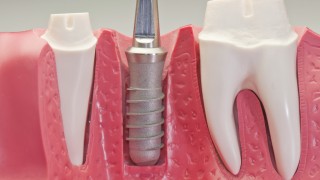 Dental Implant Model