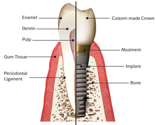 What Are The Benefits Of Getting Tooth Crown Replacement?